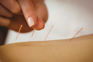 Dry-needling & Acupuncture